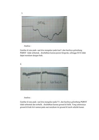 3.
Analisa :
Gambar di atas pada saat kita mengukur pada lead 1,dan hasilnya gelombang
PQRST tidak terbentuk. disebabkan karena pasien bergerak, sehingga ECG tidak
dapat merekam dengan baik.
4.
Analisa :
Gambar di atas pada saat kita mengukur pada V1, dan hasilnya gelombang PQRST
tidak terbentuk dan terbalik. disebabkan karena ground di balik. Yang seharusnya
ground di kaki kiri namun pada saat merekam ini ground di taroh sebelah kanan.
 