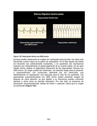 Figura 132 Taquicardia rítmica con QRS ancho
Aunque pueden observarse en sujetos sin cardiopatía estructurada, son tanto más
frecuentes cuanto mayor es el grado de cardiopatía. En la fase aguda del infarto
de miocardio son prácticamente constantes, y en pacientes con insuficiencia
cardíaca son habitualmente el desencadenante de la muerte súbita. Es de gran
interés clínico realizar el diagnóstico diferencial de las taquicardias rítmicas con
QRS ancho. Su origen puede ser ventricular, con elevado riesgo para el paciente,
o supraventricular, con conducción aberrante por los ventrículos, que
habitualmente no representan una amenaza para la vida de los pacientes. Las
taquicardias supraventriculares con QRS ancho suelen presentar imagen de
bloqueo de rama derecha, ya que debido a su frecuencia pueden encontrar
siempre a dicha rama en período refractario. Por otro lado, la presencia de
disociación auriculoventricular, latidos de fusión o capturas, indica que su origen
es ventricular (Figura 133).




                                         100
 