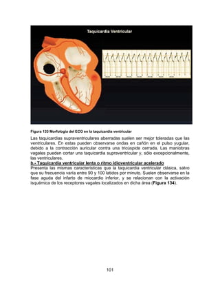 Figura 133 Morfología del ECG en la taquicardia ventricular
Las taquicardias supraventriculares aberradas suelen ser mejor toleradas que las
ventriculares. En estas pueden observarse ondas en cañón en el pulso yugular,
debido a la contracción auricular contra una tricúspide cerrada. Las maniobras
vagales pueden cortar una taquicardia supraventricular y, sólo excepcionalmente,
las ventriculares.
b.- Taquicardia ventricular lenta o ritmo idioventricular acelerado
Presenta las mismas características que la taquicardia ventricular clásica, salvo
que su frecuencia varía entre 90 y 100 latidos por minuto. Suelen observarse en la
fase aguda del infarto de miocardio inferior, y se relacionan con la activación
isquémica de los receptores vagales localizados en dicha área (Figura 134).




                                            101
 