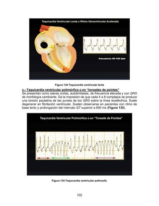Figura 134 Taquicardia ventricular lenta
c.- Taquicardia ventricular polimórfica o en “torsades de pointes”
Se presentan como salvas cortas, autolimitadas, de frecuencia elevada y con QRS
de morfología cambiante. Da la impresión de que cada 4 a 8 complejos se produce
una torsión paulatina de las puntas de los QRS sobre la línea isoeléctrica. Suele
degenerar en fibrilación ventricular. Suelen observarse en pacientes con ritmo de
base lento y prolongación del intervalo QT superior a 600 ms (Figura 135).




                    Figura 135 Taquicardia ventricular polimorfa.




                                        102
 