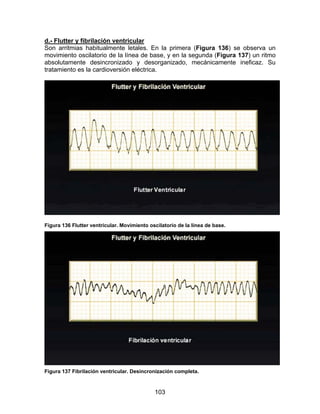 d.- Flutter y fibrilación ventricular
Son arritmias habitualmente letales. En la primera (Figura 136) se observa un
movimiento oscilatorio de la línea de base, y en la segunda (Figura 137) un ritmo
absolutamente desincronizado y desorganizado, mecánicamente ineficaz. Su
tratamiento es la cardioversión eléctrica.




Figura 136 Flutter ventricular. Movimiento oscilatorio de la línea de base.




Figura 137 Fibrilación ventricular. Desincronización completa.



                                             103
 