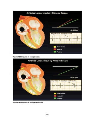 Figura 139 Impulso de escape nodal.




Figura 140 Impulso de escape ventricular




                                           105
 