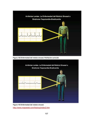 Figura 142 Enfermedad del nódulo sinusal. Fibrilación auricular




Figura 143 Enfermedad del nódulo sinusal.
http://www.mapaweb.com/hta/ecg/index2.htm


                                            107
 