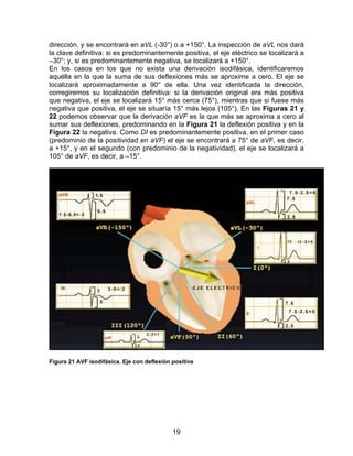 dirección, y se encontrará en aVL (-30°) o a +150°. La inspección de aVL nos dará
la clave definitiva: si es predominantemente positiva, el eje eléctrico se localizará a
–30°; y, si es predominantemente negativa, se localizará a +150°.
En los casos en los que no exista una derivación isodifásica, identificaremos
aquélla en la que la suma de sus deflexiones más se aproxime a cero. El eje se
localizará aproximadamente a 90° de ella. Una vez identificada la dirección,
corregiremos su localización definitiva: si la derivación original era más positiva
que negativa, el eje se localizará 15° más cerca (75°), mientras que si fuese más
negativa que positiva, el eje se situaría 15° más lejos (105°). En las Figuras 21 y
22 podemos observar que la derivación aVF es la que más se aproxima a cero al
sumar sus deflexiones, predominando en la Figura 21 la deflexión positiva y en la
Figura 22 la negativa. Como DI es predominantemente positiva, en el primer caso
(predominio de la positividad en aVF) el eje se encontrará a 75° de aVF, es decir,
a +15°, y en el segundo (con predominio de la negatividad), el eje se localizará a
105° de aVF, es decir, a –15°.




Figura 21 AVF isodifásica. Eje con deflexión positiva




                                             19
 