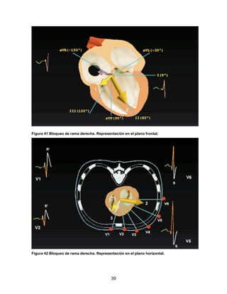 Figura 41 Bloqueo de rama derecha. Representación en el plano frontal.




Figura 42 Bloqueo de rama derecha. Representación en el plano horizontal.




                                           39
 