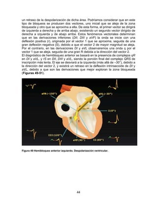 un retraso de la despolarización de dicha área. Podríamos considerar que en este
tipo de bloqueos se producen dos vectores, uno inicial que se aleja de la zona
bloqueada y otro que se aproxima a ella. De esta forma, el primer vector se dirigirá
de izquierda a derecha y de arriba abajo, existiendo un segundo vector dirigido de
derecha a izquierda y de abajo arriba. Estos fenómenos vectoriales determinan
que en las derivaciones inferiores (DII, DIII y aVF) la onda se inicie con una
deflexión positiva (r), originada por el vector 1 que se aproxima, seguida de una
gran deflexión negativa (S), debido a que el vector 2 de mayor magnitud se aleja.
Por el contrario, en las derivaciones DI y aVL observaremos una onda q por el
vector 1 que se aleja, seguida de una gran R debida a la dirección del vector 2.
El diagnóstico de hemibloqueo anterior se basará en la presencia de complejos qR
en DI y aVL, y rS en DII, DIII y aVL, siendo la porción final del complejo QRS de
inscripción más lenta. El eje se desviará a la izquierda (más allá de –30°), debido a
la dirección del vector 2, y existirá un retraso en la deflexión intrinsecoide de DI y
aVL, debido a que son las derivaciones que mejor exploran la zona bloqueada
(Figuras 49-51).




Figura 49 Hemibloqueo anterior izquierdo. Despolarización ventricular.




                                            44
 