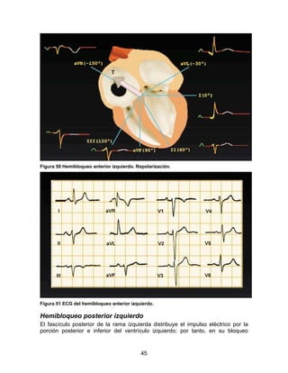 Figura 50 Hemibloqueo anterior izquierdo. Repolarización.




Figura 51 ECG del hemibloqueo anterior izquierdo.

Hemibloqueo posterior izquierdo
El fascículo posterior de la rama izquierda distribuye el impulso eléctrico por la
porción posterior e inferior del ventrículo izquierdo; por tanto, en su bloqueo


                                            45
 