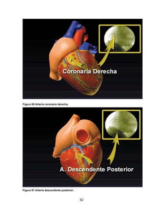 Figura 60 Arteria coronaria derecha.




Figura 61 Arteria descendente posterior.


                                           52
 