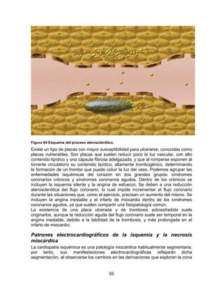 Figura 64 Esquema del proceso aterosclerótico.
Existe un tipo de placas con mayor susceptibilidad para ulcerarse, conocidas como
placas vulnerables. Son placas que suelen reducir poco la luz vascular, con alto
contenido lipídico y una cápsula fibrosa adelgazada, y que al romperse exponen al
torrente circulatorio su contenido lipídico, altamente trombogénico, determinando
la formación de un trombo que puede ocluir la luz del vaso. Podemos agrupar las
enfermedades isquémicas del corazón en dos grandes grupos: síndromes
coronarios crónicos y síndromes coronarios agudos. Dentro de los crónicos se
incluyen la isquemia silente y la angina de esfuerzo. Se deben a una reducción
aterosclerótica del flujo coronario, lo cual impide incrementar el flujo coronario
durante las situaciones que, como el ejercicio, precisan un aumento del mismo. Se
incluyen la angina inestable y el infarto de miocardio dentro de los síndromes
coronarios agudos, ya que suelen compartir una fisiopatología común.
La existencia de una placa ulcerada y de trombosis sobreañadida suele
originarlos, aunque la reducción aguda del flujo coronario suele ser temporal en la
angina inestable, debido a la labilidad de la trombosis, y más prolongada en el
infarto de miocardio.

Patrones electrocardiográficos de la isquemia y la necrosis
miocárdica
La cardiopatía isquémica es una patología miocárdica habitualmente segmentaria;
por tanto, sus manifestaciones electrocardiográficas reflejarán dicha
segmentación, al observarse los cambios en las derivaciones que exploran la zona


                                           55
 