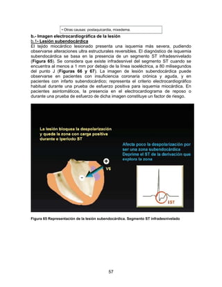 • Otras causas: postaquicardia, mixedema.
b.- Imagen electrocardiográfica de la lesión
b.1- Lesión subendocárdica
El tejido miocárdico lesionado presenta una isquemia más severa, pudiendo
observarse alteraciones ultra estructurales reversibles. El diagnóstico de isquemia
subendocárdica se basa en la presencia de un segmento ST infradesnivelado
(Figura 65). Se considera que existe infradesnivel del segmento ST cuando se
encuentra al menos a 1 mm por debajo de la línea isoeléctrica, a 80 milisegundos
del punto J (Figuras 66 y 67). La imagen de lesión subendocárdica puede
observarse en pacientes con insuficiencia coronaria crónica y aguda, y en
pacientes con infarto subendocárdico; representa el criterio electrocardiográfico
habitual durante una prueba de esfuerzo positiva para isquemia miocárdica. En
pacientes asintomáticos, la presencia en el electrocardiograma de reposo o
durante una prueba de esfuerzo de dicha imagen constituye un factor de riesgo.




Figura 65 Representación de la lesión subendocárdica. Segmento ST infradesnivelado




                                           57
 