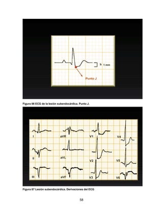 Figura 66 ECG de la lesión subendocárdica. Punto J.




Figura 67 Lesión subendocárdica. Derivaciones del ECG


                                           58
 