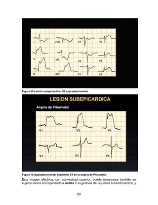 Figura 69 Lesión subepicárdica. ST supradesnivelado




Figura 70 Supradesnivel del segmento ST en la angina de Prinzmetal
Esta imagen eléctrica, con convexidad superior, puede observarse también en
sujetos sanos acompañando a ondas T sugestivas de isquemia subendocárdica, y


                                           60
 