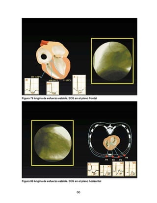 Figura 79 Angina de esfuerzo estable. ECG en el plano frontal




Figura 80 Angina de esfuerzo estable. ECG en el plano horizontal



                                            66
 