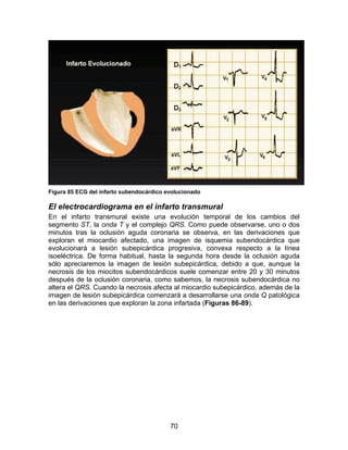 Figura 85 ECG del infarto subendocárdico evolucionado

El electrocardiograma en el infarto transmural
En el infarto transmural existe una evolución temporal de los cambios del
segmento ST, la onda T y el complejo QRS. Como puede observarse, uno o dos
minutos tras la oclusión aguda coronaria se observa, en las derivaciones que
exploran el miocardio afectado, una imagen de isquemia subendocárdica que
evolucionará a lesión subepicárdica progresiva, convexa respecto a la línea
isoeléctrica. De forma habitual, hasta la segunda hora desde la oclusión aguda
sólo apreciaremos la imagen de lesión subepicárdica, debido a que, aunque la
necrosis de los miocitos subendocárdicos suele comenzar entre 20 y 30 minutos
después de la oclusión coronaria, como sabemos, la necrosis subendocárdica no
altera el QRS. Cuando la necrosis afecta al miocardio subepicárdico, además de la
imagen de lesión subepicárdica comenzará a desarrollarse una onda Q patológica
en las derivaciones que exploran la zona infartada (Figuras 86-89).




                                          70
 