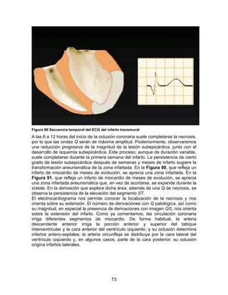 Figura 90 Secuencia temporal del ECG del infarto transmural
A las 6 a 12 horas del inicio de la oclusión coronaria suele completarse la necrosis,
por lo que las ondas Q serán de máxima amplitud. Posteriormente, observaremos
una reducción progresiva de la magnitud de la lesión subepicárdica, junto con el
desarrollo de isquemia subepicárdica. Este proceso, aunque de duración variable,
suele completarse durante la primera semana del infarto. La persistencia de cierto
grado de lesión subepicárdica después de semanas y meses de infarto sugiere la
transformación aneurismática de la zona infartada. En la Figura 90, que refleja un
infarto de miocardio de meses de evolución, se aprecia una zona infartada. En la
Figura 91, que refleja un infarto de miocardio de meses de evolución, se aprecia
una zona infartada aneurismática que, en vez de acortarse, se expande durante la
sístole. En la derivación que explora dicha área, además de una Q de necrosis, se
observa la persistencia de la elevación del segmento ST.
El electrocardiograma nos permite conocer la localización de la necrosis y nos
orienta sobre su extensión. El número de derivaciones con Q patológica, así como
su magnitud, en especial la presencia de derivaciones con imagen QS, nos orienta
sobre la extensión del infarto. Como ya comentamos, las circulación coronaria
irriga diferentes segmentos de miocardio. De forma habitual, la arteria
descendente anterior irriga la porción anterior y superior del tabique
interventricular y la cara anterior del ventrículo izquierdo, y su oclusión determina
infartos antero-septales; la arteria circunfleja se distribuye por la cara lateral del
ventrículo izquierdo y, en algunos casos, parte de la cara posterior; su oclusión
origina infartos laterales.




                                           73
 