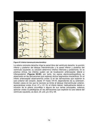 Figura 91 Infarto transmural aneurismático
La arteria coronaria derecha irriga la pared libre del ventrículo derecho, la porción
inferior y posterior del tabique interventricular y la pared inferior y posterior del
ventrículo izquierdo; su oclusión determina infartos inferiores y posteriores. En la
práctica clínica, los infartos suelen ser de localización anteroseptal, lateral e
inferoposterior (Figuras 92-95): por tanto, los signos electrocardiográficos se
observarán en las derivaciones que exploran dichos segmentos miocárdicos. En el
infarto anteroseptal observaremos ondas Q en las derivaciones que exploran la
cara anterior del corazón, desde V1 hasta V4-V5, dependiendo de su extensión.
Existen casos en los que la necrosis se limita al tabique interventricular anterior,
apreciándose ondas Q en V1 y V2. En el infarto lateral, habitualmente debido a
oclusión de la arteria circunfleja o alguna de sus ramas principales, solemos
apreciar ondas Q patológicas en las derivaciones que exploran la cara lateral del
ventrículo izquierdo, es decir, DI, aVL y/o V5 y V6.




                                             74
 