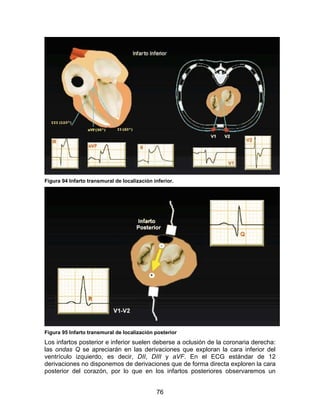 Figura 94 Infarto transmural de localización inferior.




Figura 95 Infarto transmural de localización posterior
Los infartos posterior e inferior suelen deberse a oclusión de la coronaria derecha:
las ondas Q se apreciarán en las derivaciones que exploran la cara inferior del
ventrículo izquierdo, es decir, DII, DIII y aVF. En el ECG estándar de 12
derivaciones no disponemos de derivaciones que de forma directa exploren la cara
posterior del corazón, por lo que en los infartos posteriores observaremos un


                                              76
 