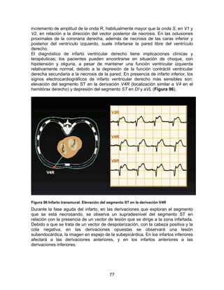 incremento de amplitud de la onda R, habitualmente mayor que la onda S, en V1 y
V2, en relación a la dirección del vector posterior de necrosis. En las oclusiones
proximales de la coronaria derecha, además de necrosis de las caras inferior y
posterior del ventrículo izquierdo, suele infartarse la pared libre del ventrículo
derecho.
El diagnóstico de infarto ventricular derecho tiene implicaciones clínicas y
terapéuticas; los pacientes pueden encontrarse en situación de choque, con
hipotensión y oliguria, a pesar de mantener una función ventricular izquierda
relativamente normal, debido a la depresión de la función contráctil ventricular
derecha secundaria a la necrosis de la pared. En presencia de infarto inferior, los
signos electrocardiográficos de infarto ventricular derecho más sensibles son:
elevación del segmento ST en la derivación V4R (localización similar a V4 en el
hemitórax derecho) y depresión del segmento ST en DI y aVL (Figura 96).




Figura 96 Infarto transmural. Elevación del segmento ST en la derivación V4R
Durante la fase aguda del infarto, en las derivaciones que exploran el segmento
que se está necrosando, se observa un supradesnivel del segmento ST en
relación con la presencia de un vector de lesión que se dirige a la zona infartada.
Debido a que se trata de un vector de despolarización, con la cabeza positiva y la
cola negativa, en las derivaciones opuestas se observará una lesión
subendocárdica, la imagen en espejo de la subepicárdica. En los infartos inferiores
afectará a las derivaciones anteriores, y en los infartos anteriores a las
derivaciones inferiores.




                                            77
 
