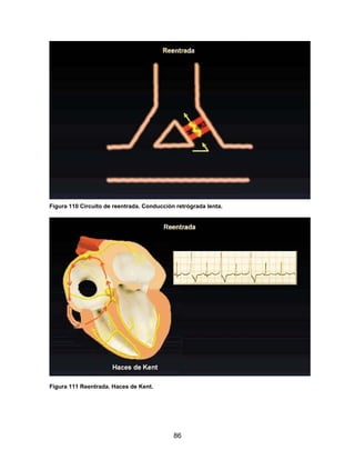 Figura 110 Circuito de reentrada. Conducción retrógrada lenta.




Figura 111 Reentrada. Haces de Kent.




                                            86
 