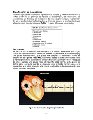 Clasificación de las arritmias
Podemos agruparlas en arritmias hiperactivas o rápidas, y arritmias hipoactivas o
lentas. Dentro de las primeras se incluyen las extrasístoles, las parasístoles, las
taquicardias, los flúteres y las fibrilaciones de origen supraventricular y ventricular.
En las segundas incluimos los impulsos y ritmos de escape, la bradicardia sinusal
y los diferentes tipos de bloqueos (Tabla 11), estos últimos ya comentados.

                        Tabla 11.- Clasificación de las arritmias

                        • Hiperactivas o rápidas
                        - Extrasístoles
                        - Parasístoles
                        - Taquicardias
                        - Flutteres
                        - Fibrilaciones
                        • Hipoactivas o lentas
                        - Impulsos y ritmos de escape
                        - Bradicardia sinusal
                        - Bloqueos
Extrasístoles
Se trata de latidos anticipados en relación con el impulso precedente, y su origen
puede ser supraventricular o ventricular. Poseen un período de acoplamiento fijo y
una pausa compensadora, que puede ser completa o incompleta. Como se
observa en las Figuras 112 y 113, la distancia desde el latido extrasistólico hasta
el normal precedente es constante en las extrasístoles del mismo foco, y después
de ella se aprecia una pausa hasta el siguiente latido normal. Dicha pausa se
define como completa cuando la distancia entre el latido normal previo a la
extrasístole y el latido siguiente a la misma es el doble de la distancia entre dos
latidos normales sucesivos.




                    Figura 112 Extrasístoles. Origen supraventricular


                                             87
 