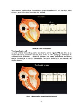 acoplamiento será variable: no muestran pausa compensadora y la distancia entre
los latidos parasistólicos guardará una relación.




                           Figura 118 Foco parasistólico.
Taquicardia sinusal
Es una arritmia frecuente y, como se observa en la Figura 119, se debe a un
incremento del automatismo sinusal. Las ondas P y los complejos QRS son de
características normales. Cuando se presenta de forma persistente en reposo
obliga a investigar la causa, debiéndose descartar, entre otras, la anemia y el
hipertiroidismo.




                   Figura 119 Incremento del automatismo sinusal.


                                        91
 