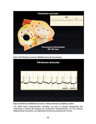 Figura 122 Fibrilación auricular. Múltiples focos de microentrada




Figura 123 ECG en la fibrilación auricular: arritmia ventricular completa y ondas f
Los QRS serán habitualmente normales, ya que el impulso despolariza los
ventrículos a través del sistema de conducción intraventricular. Es una arritmia
relativamente frecuente, con diferentes formas de presentación clínica.


                                              94
 