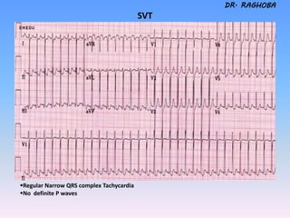 Svt Complex Ecg tutorial (2) | PDF