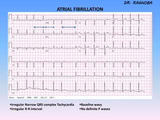Ecg tutorial (2) | PDF