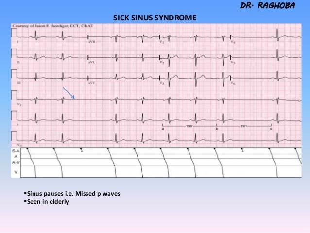 icd 10 for sick sinus syndrome icd 10 for sick sinus syndrome