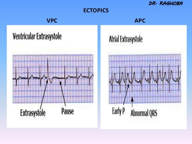 Ecg tutorial (2)