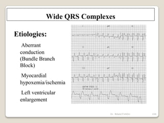 Dr. Bibek/CVASU 104
Wide QRS Complexes
Etiologies:
Aberrant
conduction
(Bundle Branch
Block)
Myocardial
hypoxemia/ischemia
Left ventricular
enlargement
 