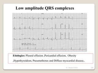 Dr. Bibek/CVASU 105
Low amplitude QRS complexes
Etiologies: Pleural effusion ,Pericardial effusion, Obesity
,Hypothyroidism, Pneumothorax and Diffuse myocardial disease.
 