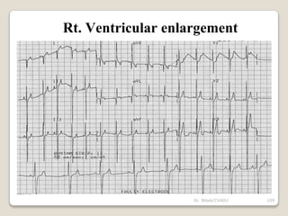 Dr. Bibek/CVASU 109
Rt. Ventricular enlargement
 