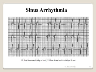 Dr. Bibek/CVASU 121
Sinus Arrhythmia
 