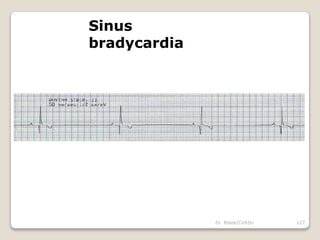 Dr. Bibek/CVASU 127
Sinus
bradycardia
 