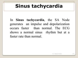 Dr. Bibek/CVASU 129
Sinus tachycardia
In Sinus tachycardia, the SA Node
generates an impulse and depolarization
occurs faster than normal. The ECG
shows a normal sinus rhythm but at a
faster rate than normal.
 