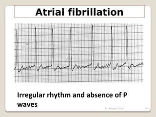 Dr. Bibek/CVASU 134
Atrial fibrillation
Irregular rhythm and absence of P
waves
 