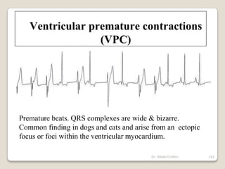 Dr. Bibek/CVASU 142
Ventricular premature contractions
(VPC)
Premature beats. QRS complexes are wide & bizarre.
Common finding in dogs and cats and arise from an ectopic
focus or foci within the ventricular myocardium.
 