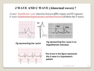 J WAVE AND U WAVE (Abnormal waves) ?
J wave= hypothermic wave (Junction between QRS complex and ST segment)
U wave=hypokalemia/hypercalcemia and thyrotoxicosis (Follows the T wave)
162
Dr. Bibek/CVASU
 