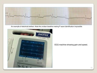 62
An example of electrical artefact. Note the unclear baseline making P wave identification impossible.
ECG machine showing gain and speed.
 