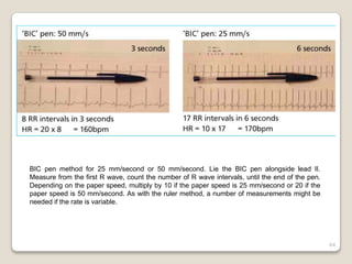 64
BIC pen method for 25 mm/second or 50 mm/second. Lie the BIC pen alongside lead II.
Measure from the first R wave, count the number of R wave intervals, until the end of the pen.
Depending on the paper speed, multiply by 10 if the paper speed is 25 mm/second or 20 if the
paper speed is 50 mm/second. As with the ruler method, a number of measurements might be
needed if the rate is variable.
 