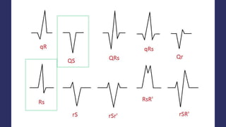 Bruagda Algorithm Ecg vtach brugada & vereckei algorithm mec elino | PPTX