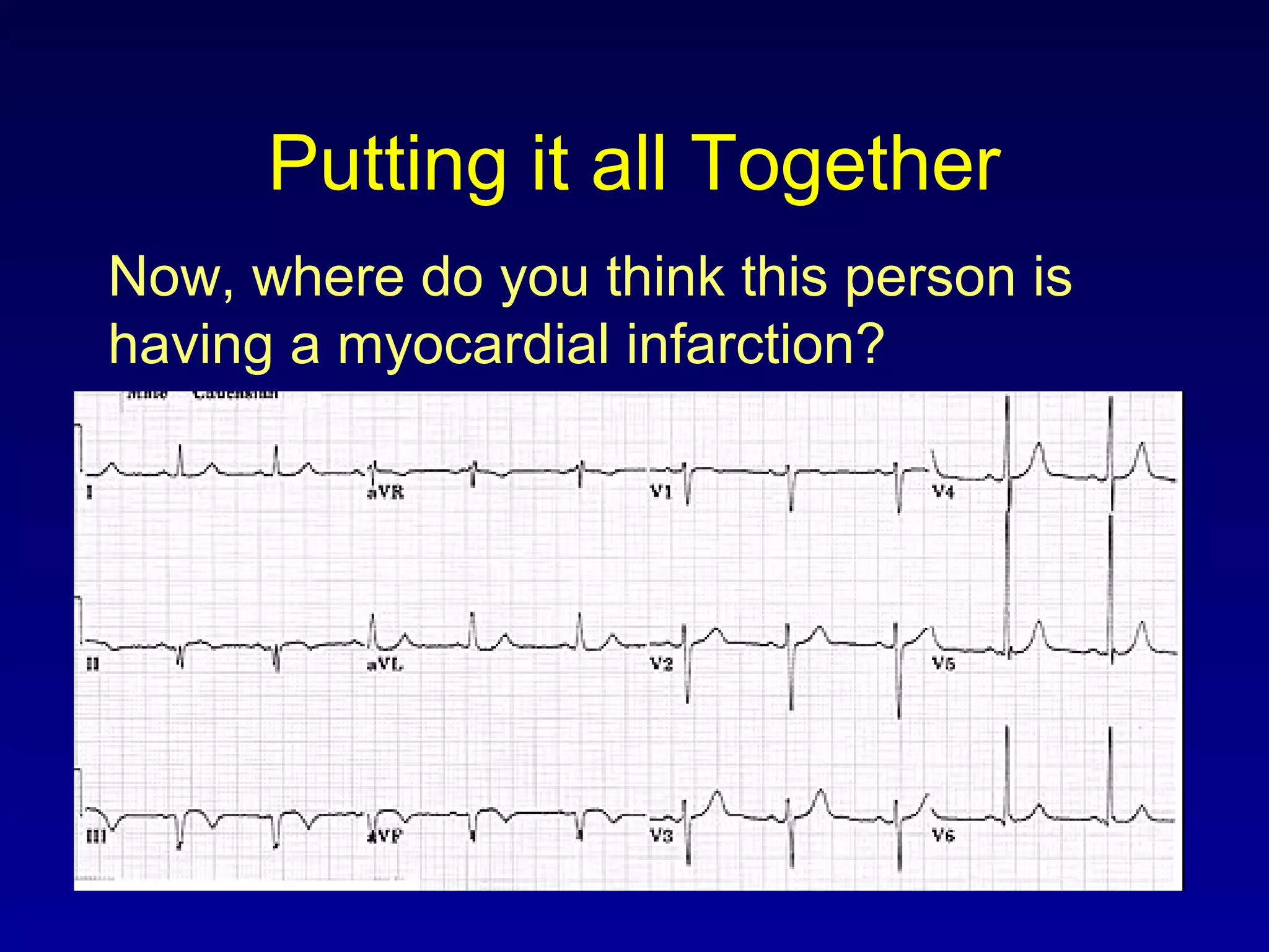 Putting it all Together
Now, where do you think this person is
having a myocardial infarction?
 