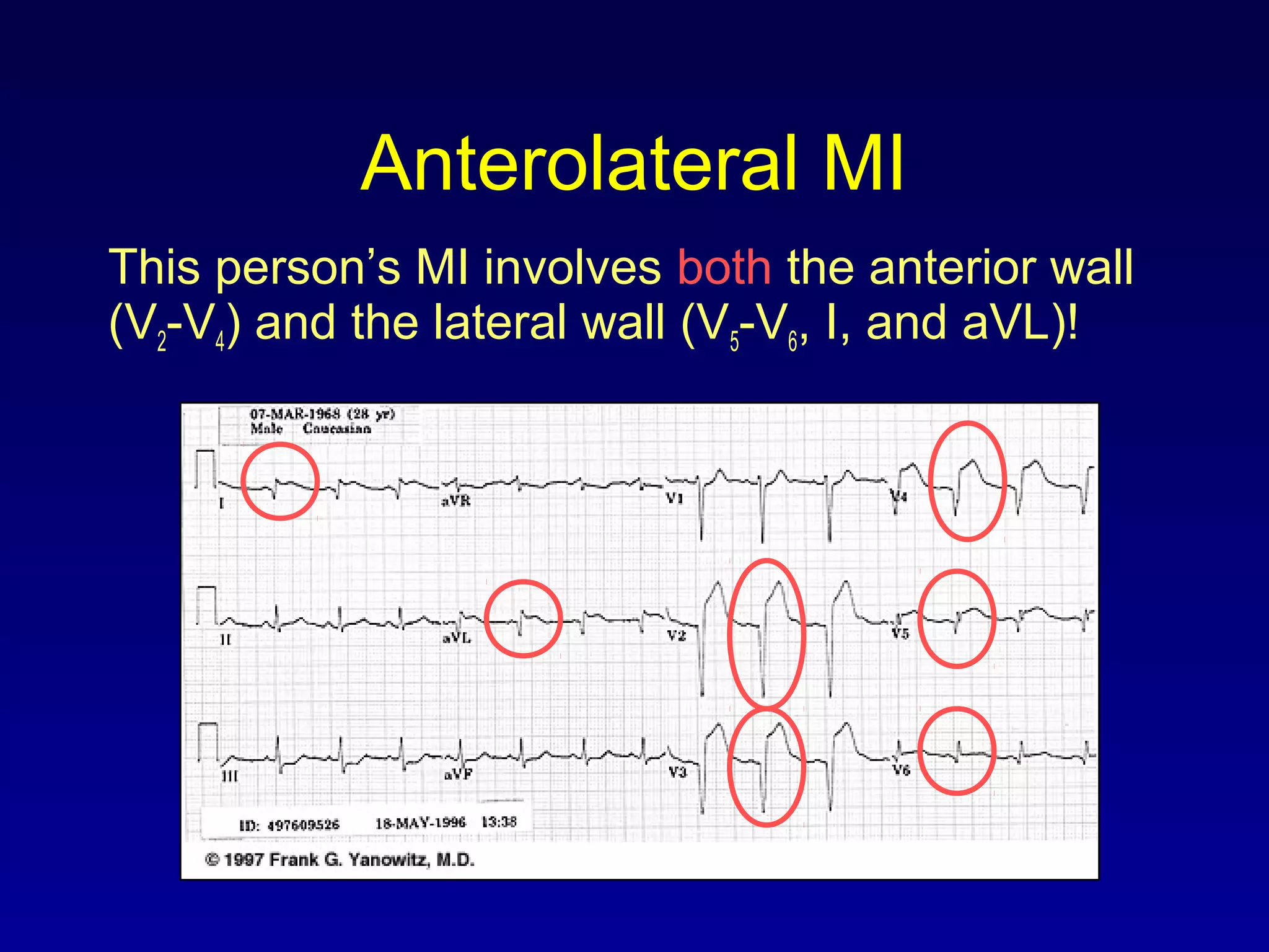 Anterolateral MI
This person’s MI involves both the anterior wall
(V2-V4) and the lateral wall (V5-V6, I, and aVL)!
 