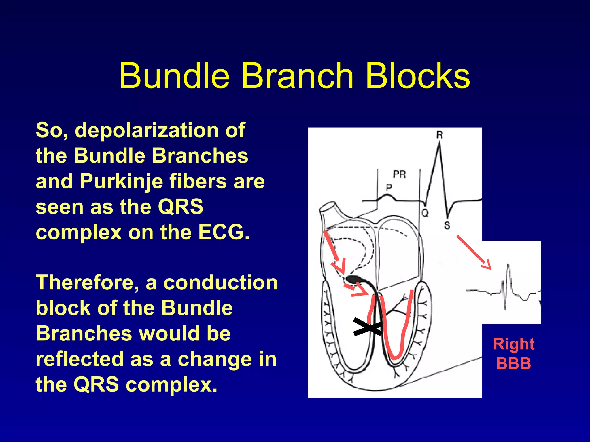 Bundle Branch Blocks
So, depolarization of
the Bundle Branches
and Purkinje fibers are
seen as the QRS
complex on the ECG.
Therefore, a conduction
block of the Bundle
Branches would be
reflected as a change in
the QRS complex.
Right
BBB
 