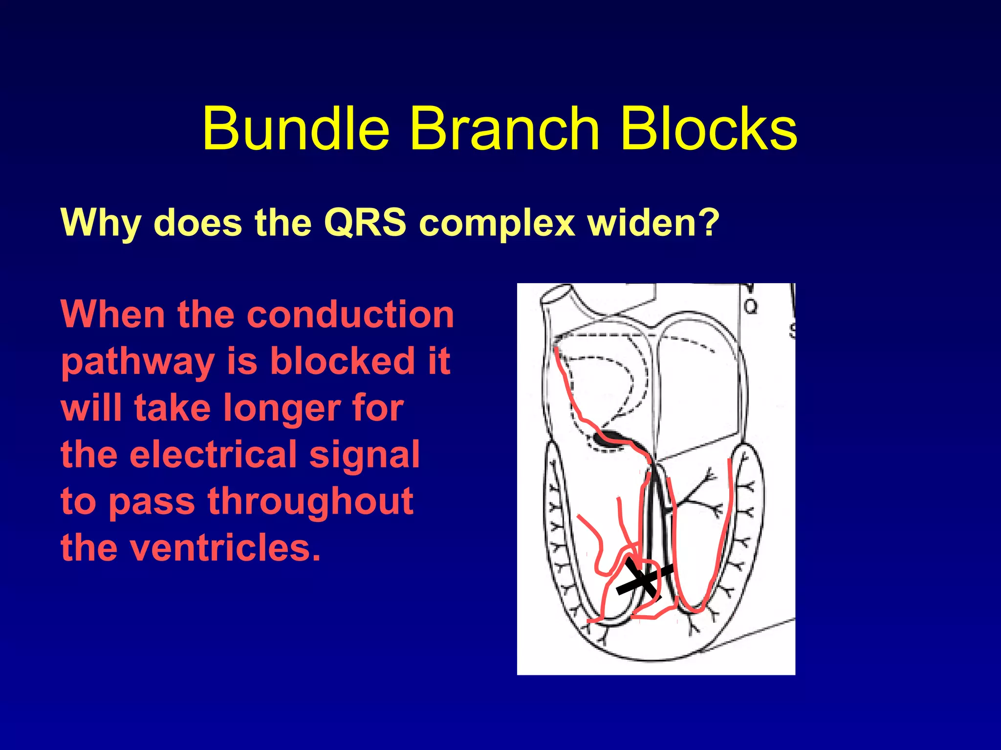 Bundle Branch Blocks
Why does the QRS complex widen?
When the conduction
pathway is blocked it
will take longer for
the electrical signal
to pass throughout
the ventricles.
 