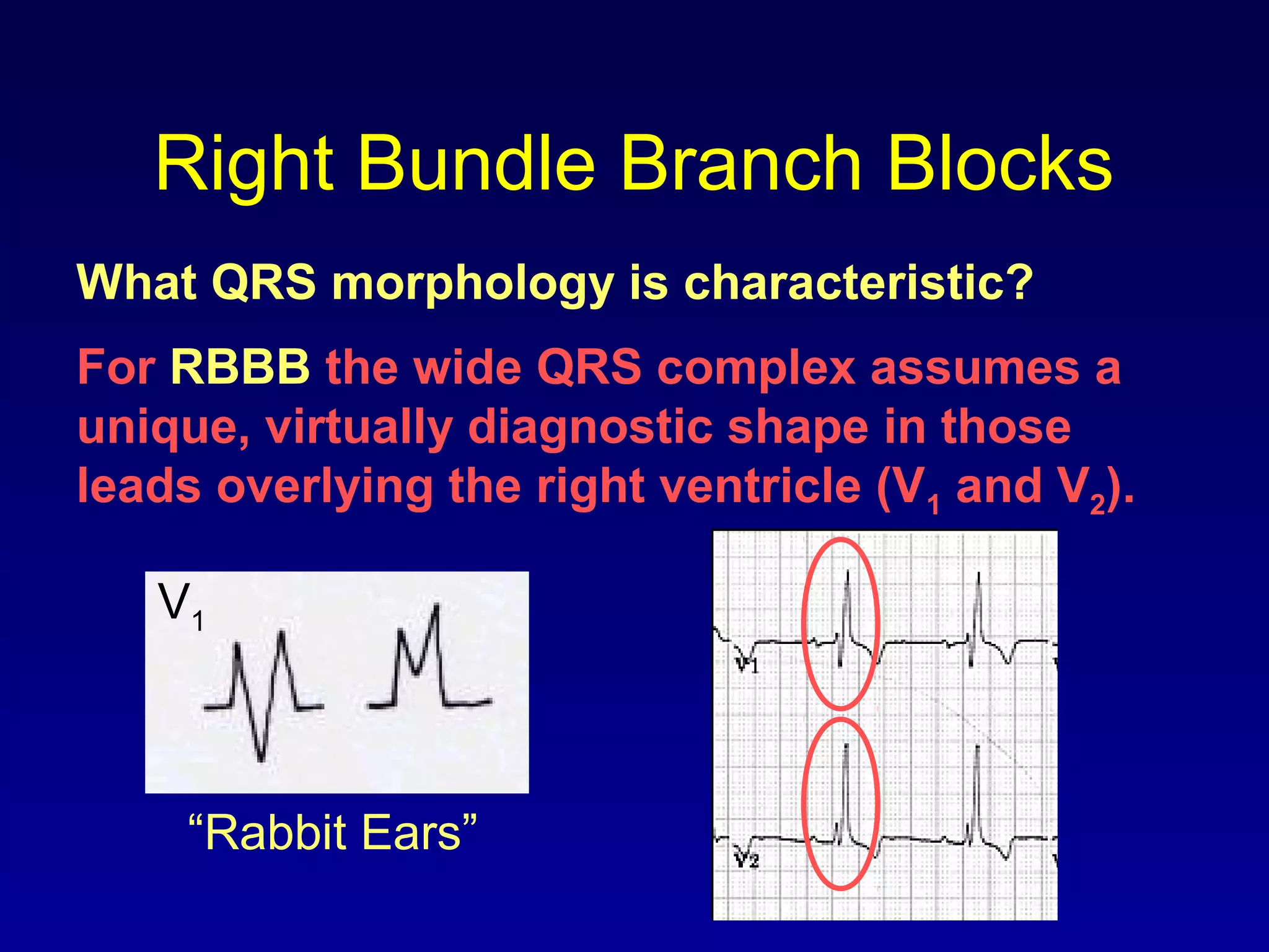 Right Bundle Branch Blocks
What QRS morphology is characteristic?
V1
For RBBB the wide QRS complex assumes a
unique, virtually diagnostic shape in those
leads overlying the right ventricle (V1 and V2).
“Rabbit Ears”
 