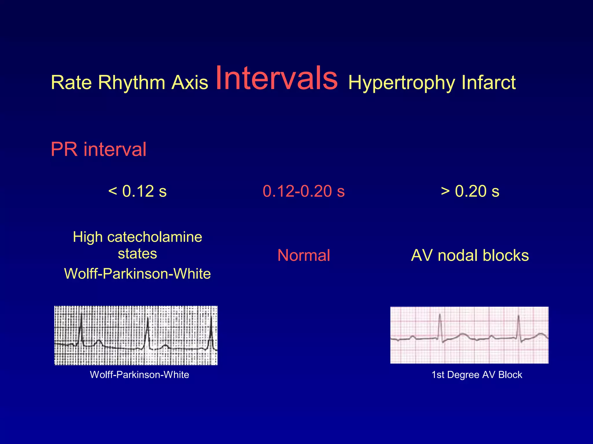 Rate Rhythm Axis Intervals Hypertrophy Infarct
PR interval
< 0.12 s 0.12-0.20 s > 0.20 s
High catecholamine
states
Wolff-Parkinson-White
Normal AV nodal blocks
Wolff-Parkinson-White 1st Degree AV Block
 