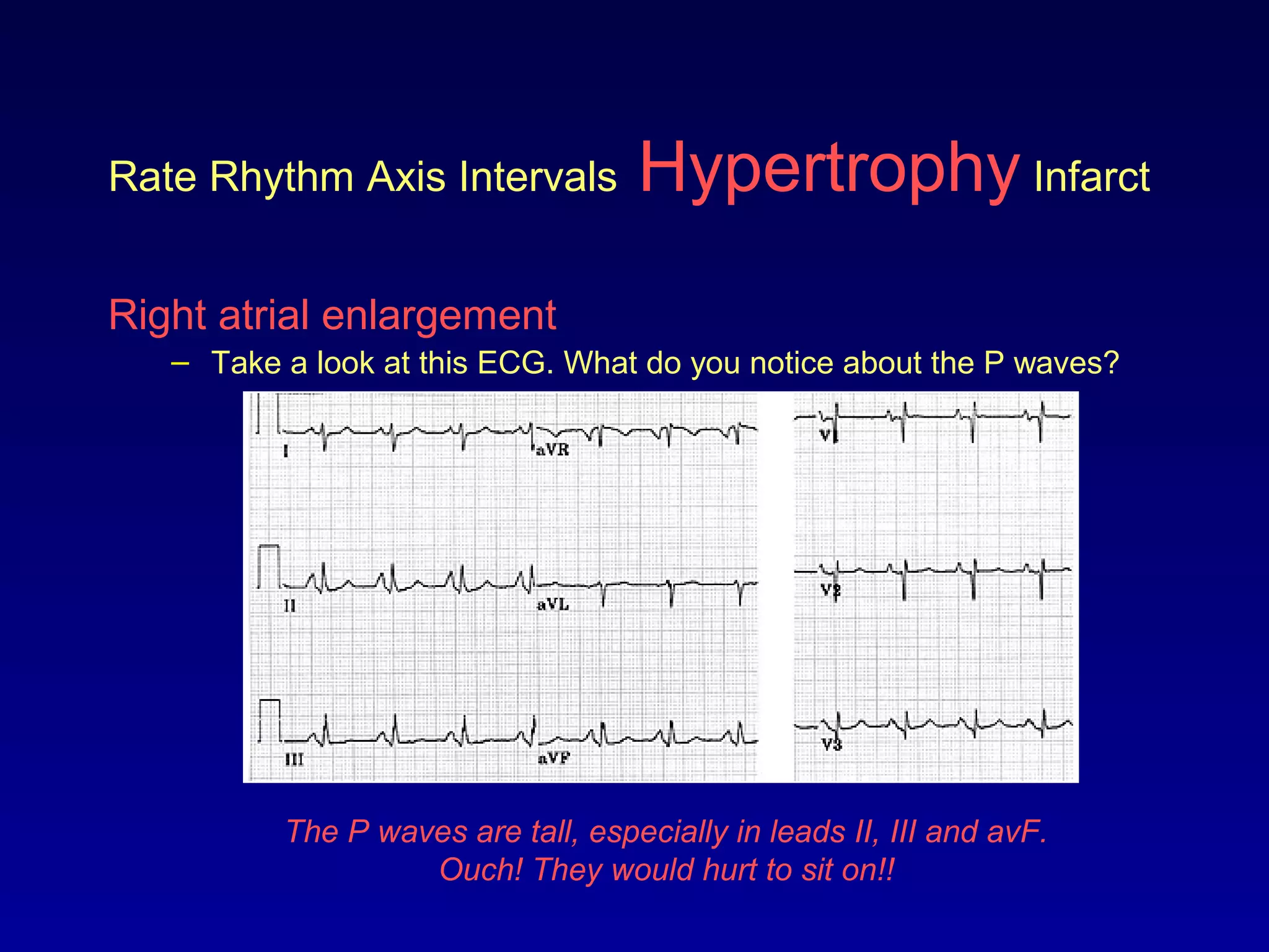 Rate Rhythm Axis Intervals Hypertrophy Infarct
Right atrial enlargement
– Take a look at this ECG. What do you notice about the P waves?
The P waves are tall, especially in leads II, III and avF.
Ouch! They would hurt to sit on!!
 