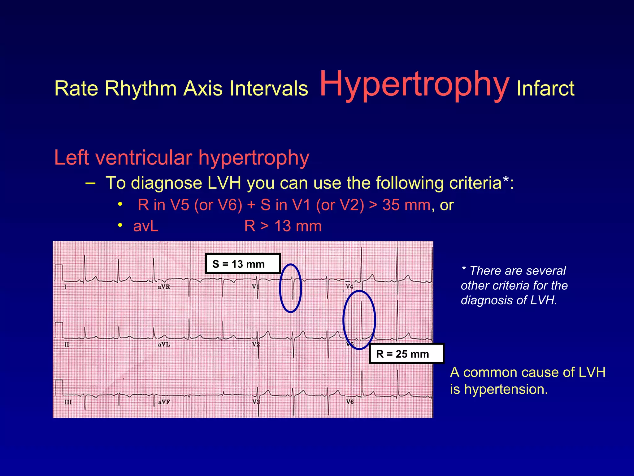 Rate Rhythm Axis Intervals Hypertrophy Infarct
Left ventricular hypertrophy
– To diagnose LVH you can use the following criteria*:
• R in V5 (or V6) + S in V1 (or V2) > 35 mm, or
• avL R > 13 mm
A common cause of LVH
is hypertension.
* There are several
other criteria for the
diagnosis of LVH.
S = 13 mm
R = 25 mm
 